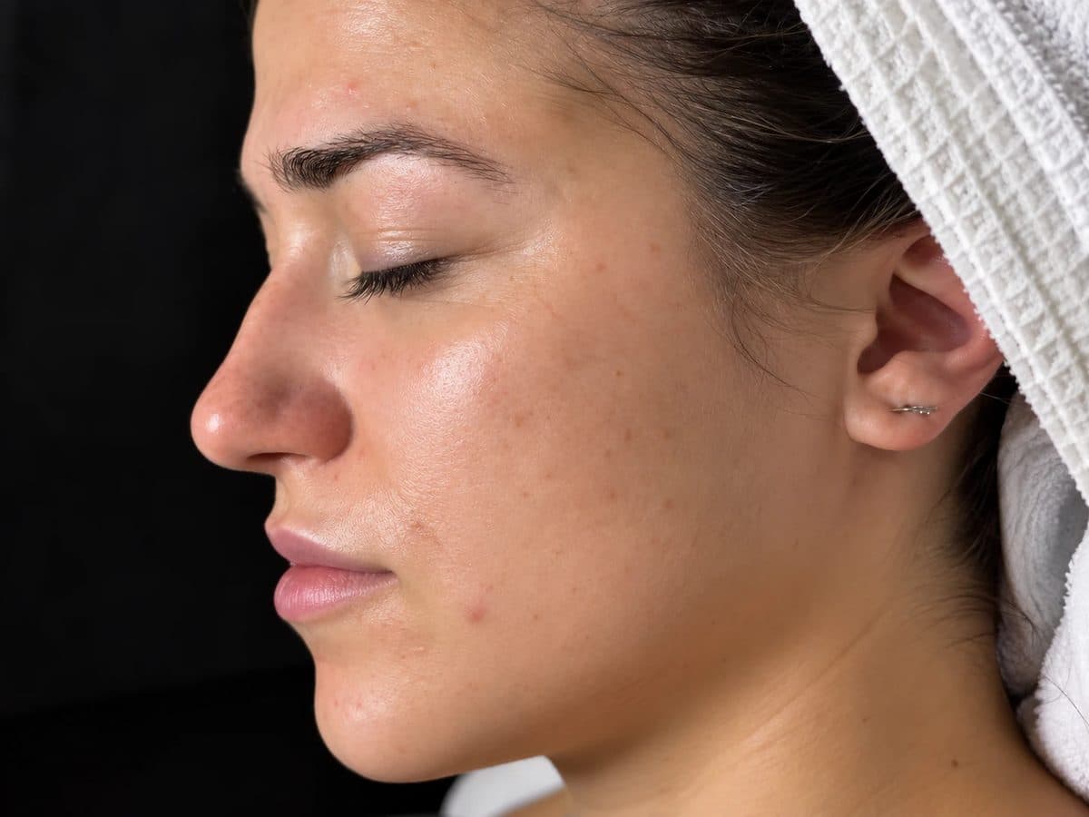 After Jet Peel Facial treatment at Allure Medical Aesthetics