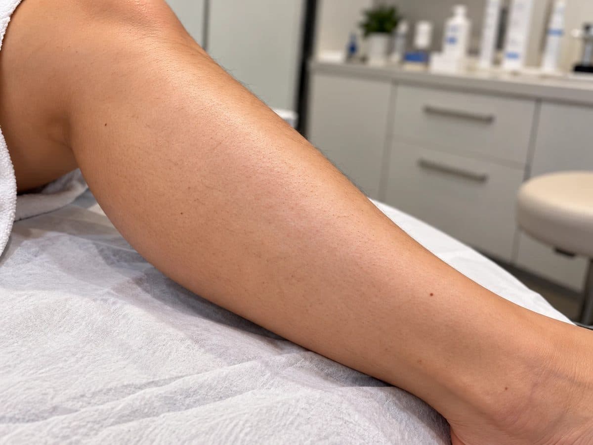 After Laser Hair Removal treatment at Allure Medical Aesthetics