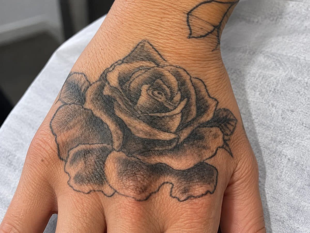 Before Laser Tattoo Removal treatment