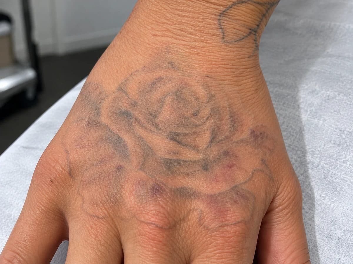 After Laser Tattoo Removal treatment at Allure Medical Aesthetics
