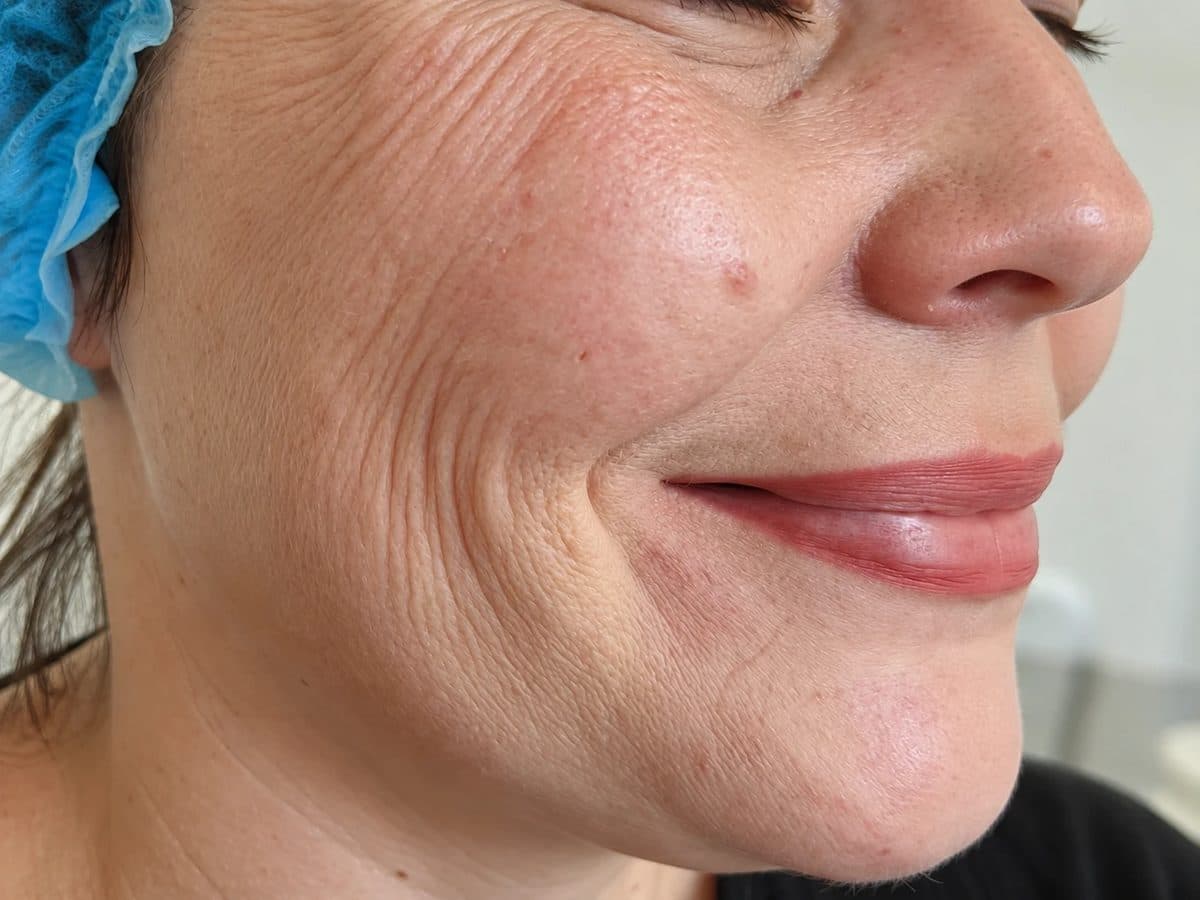 Before Skin Boosters treatment