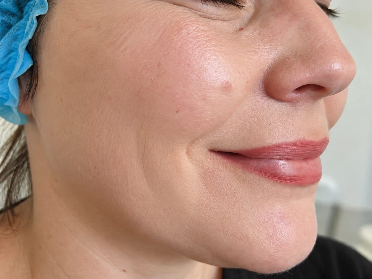 After Skin Boosters treatment at Allure Medical Aesthetics