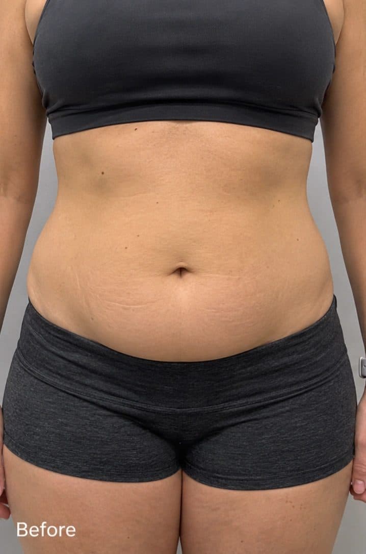 Before Emsculpt Neo Body Contouring treatment