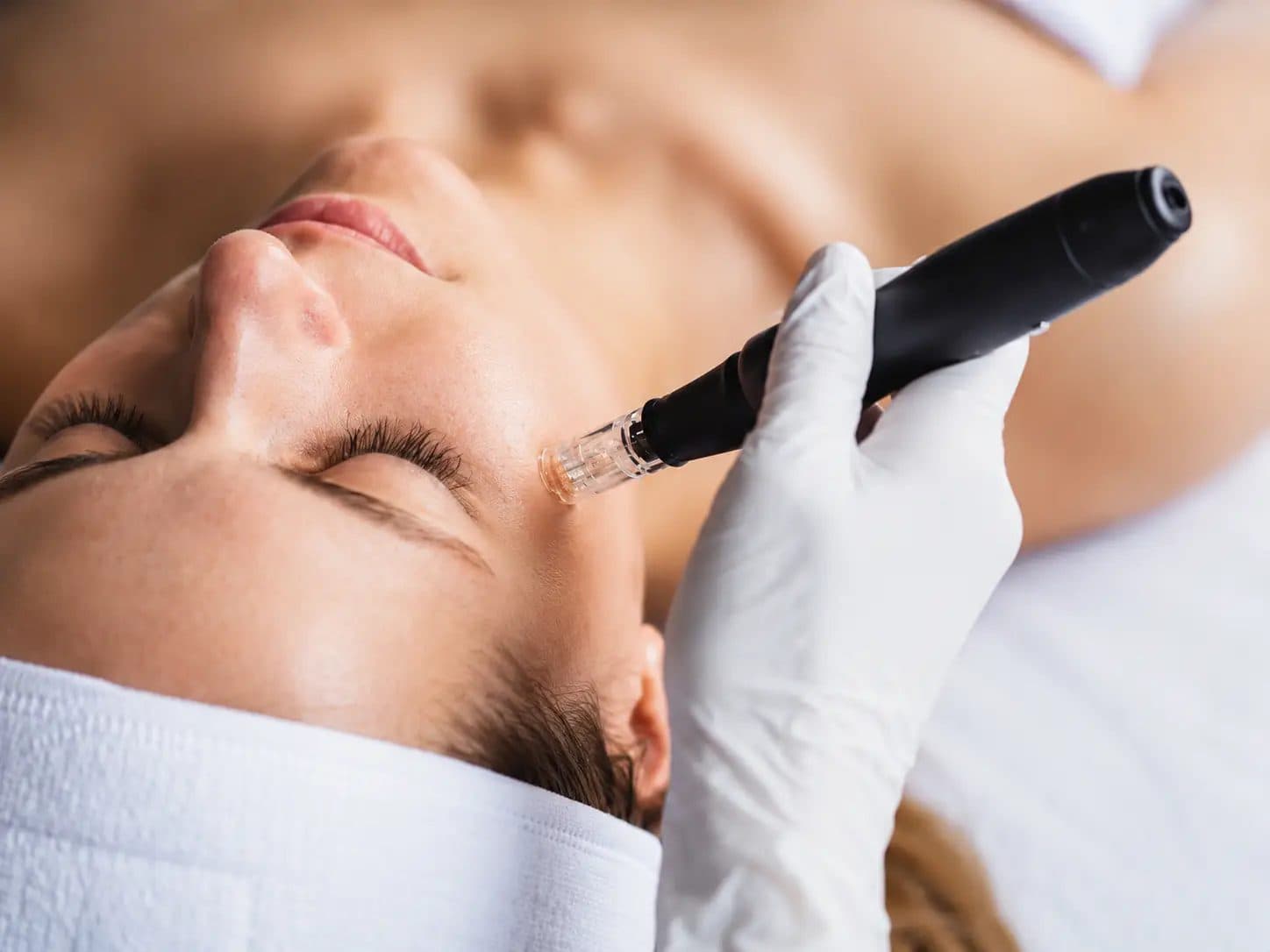 EXION RF Microneedling treatment