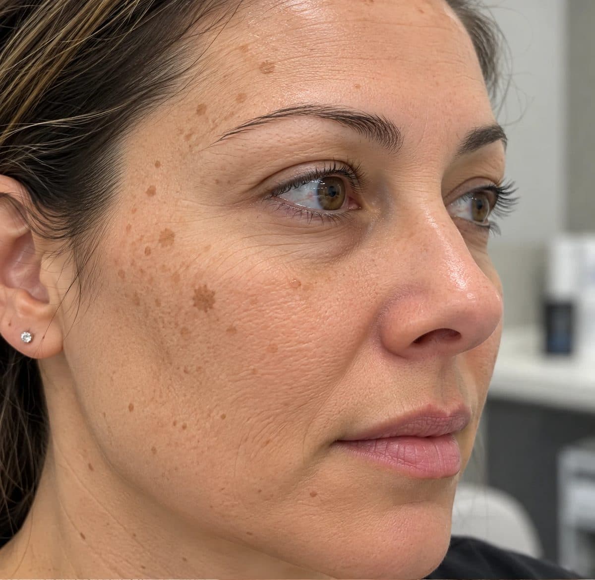 Before Freezpen Skin Lesion Removal treatment