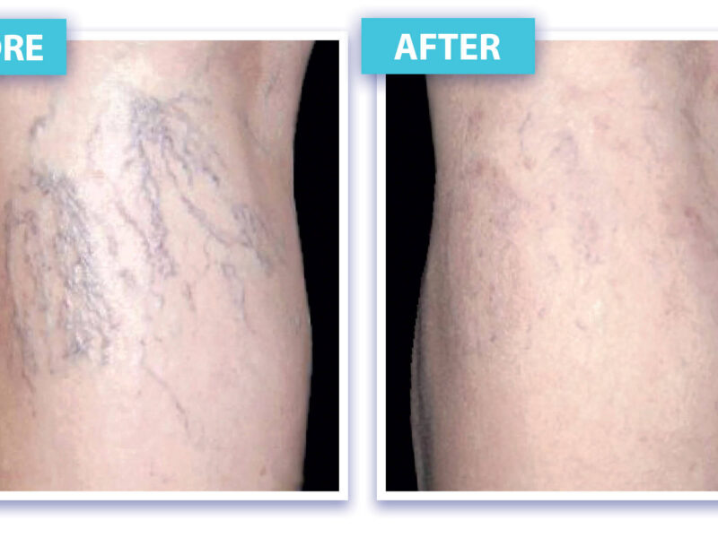 Laser Vein Removal