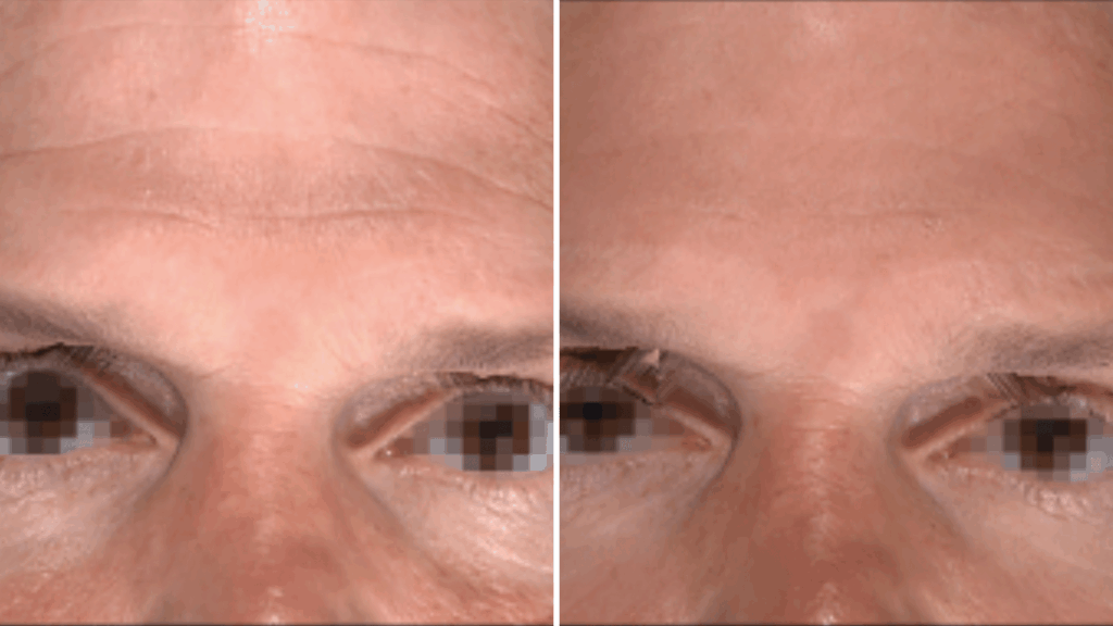 Forehead